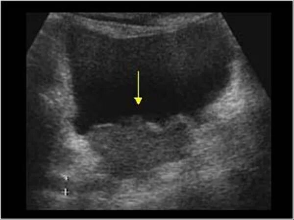 Тампонада мочевого пузыря на УЗИ. Отслоение стенки мочевого пузыря УЗИ. Трабекулярная стенка мочевого пузыря. Утолщение стенки мочевого пузыря на УЗИ. Диффузный мочевой пузырь
