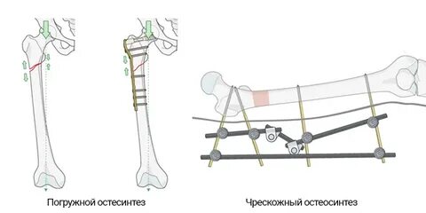 Через костный