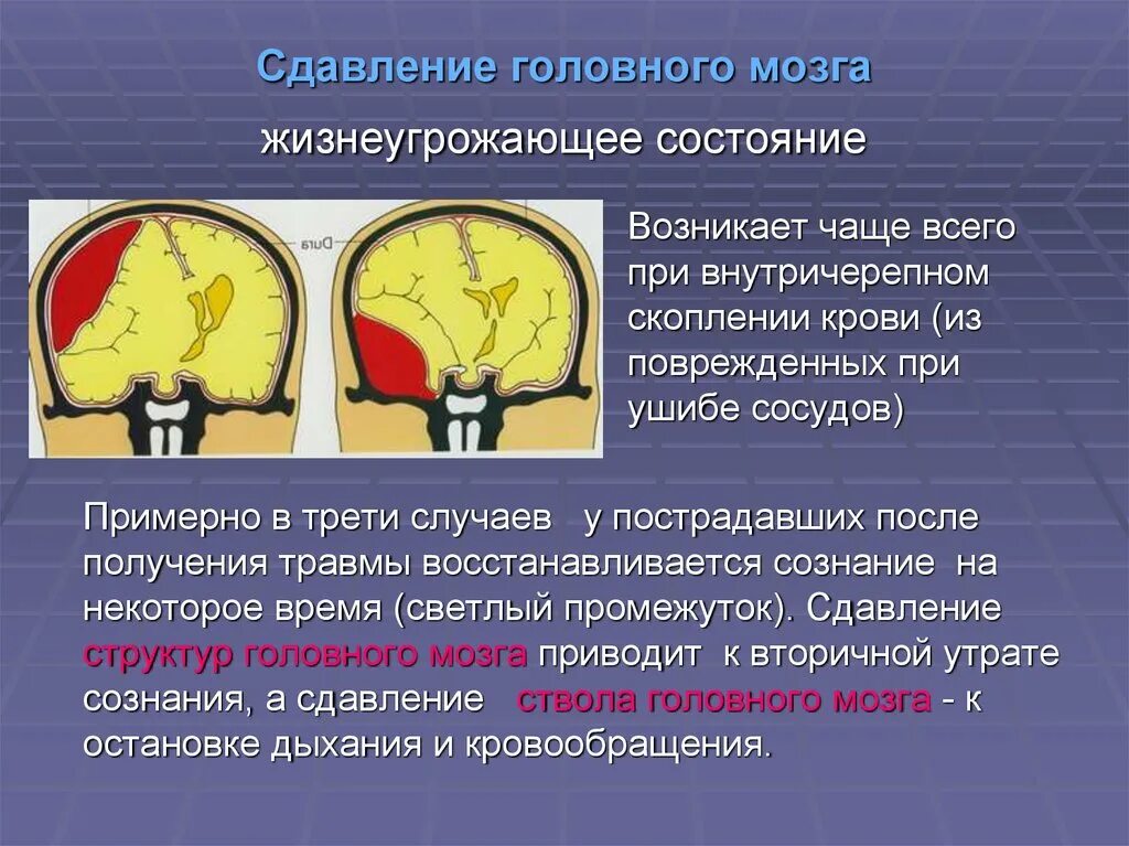 Признак жизни головного мозга. Сдавление головного мозга. Сдавление головного мозга внутричерепными гематомами. Сдавление ствола мозга. Сдавливание головного мозга клиника.