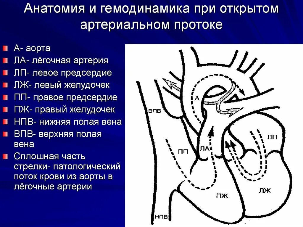 Дефект межжелудочковой перегородки гемодинамика схема. Открытый артериальный проток и дефект межпредсердной перегородки. Дефект межжелудочковой перегородки патанатомия. Открытый артериальный проток гемодинамика. Гемодинамика у детей