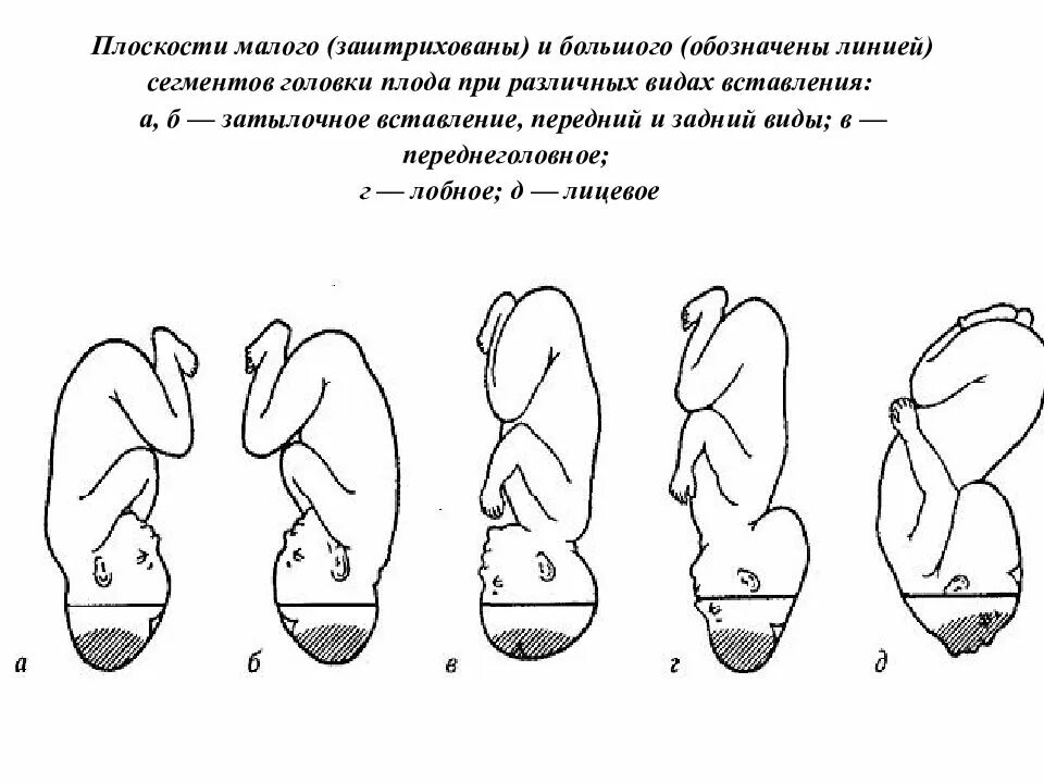 Малый сегмент плода. Сегменты головки плода акушерство. большой сегмент и малый сегмент головки плода. малый сегмент и большой сегмент головки. типы вставления головки плода.