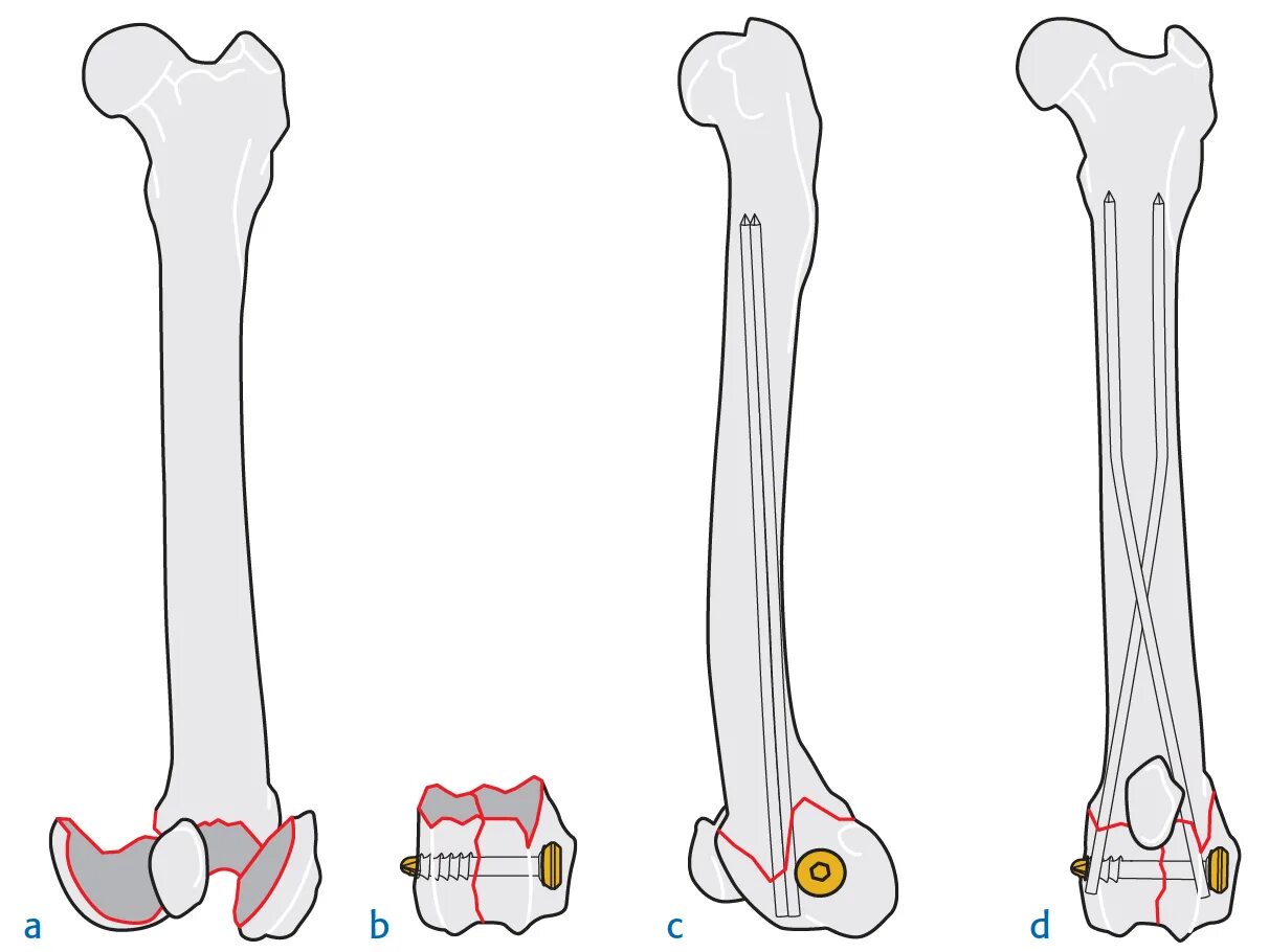 остеосинтез бедренной кости биос,. интрамедуллярный остеосинтез бедренной кости рентген.