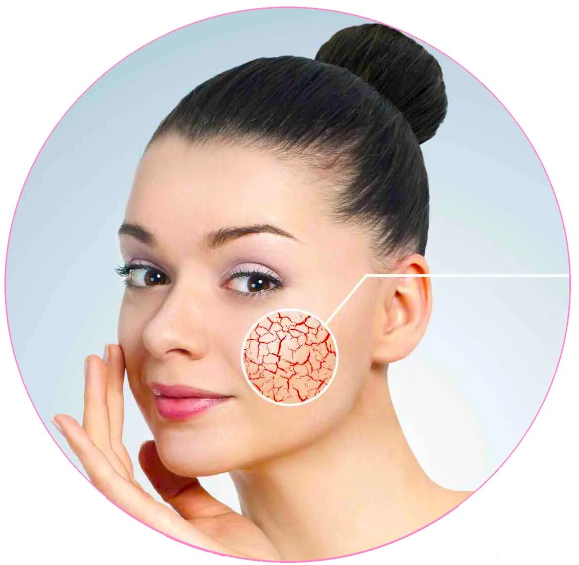 Лазерная коагуляция сосудистых звездочек. Сосудистые звездочки и купероз на лице. Купероз и сосудистые звездочки. Сеточку лазером на лице. Сеточку лазером на лице.