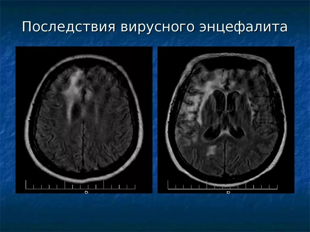 Поражение головного мозга последствия. Воспаление головного мозга. Энцефалит воспаление мозга.