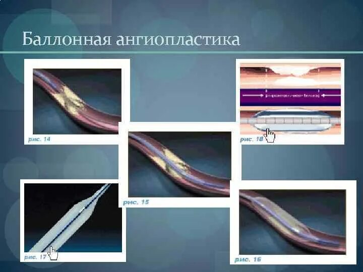 Баллонная ангиопластика нижних конечностей. Баллонная ангиопластика нижних конечностей ход операции. Баллонная ангиопластика тибиоперонеального ствола. Баллонная коронарная ангиопластика. Субинтимальная баллонная ангиопластика.