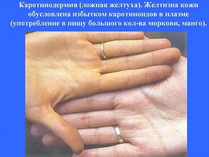 Кожа желтого цвета у мужчин причины