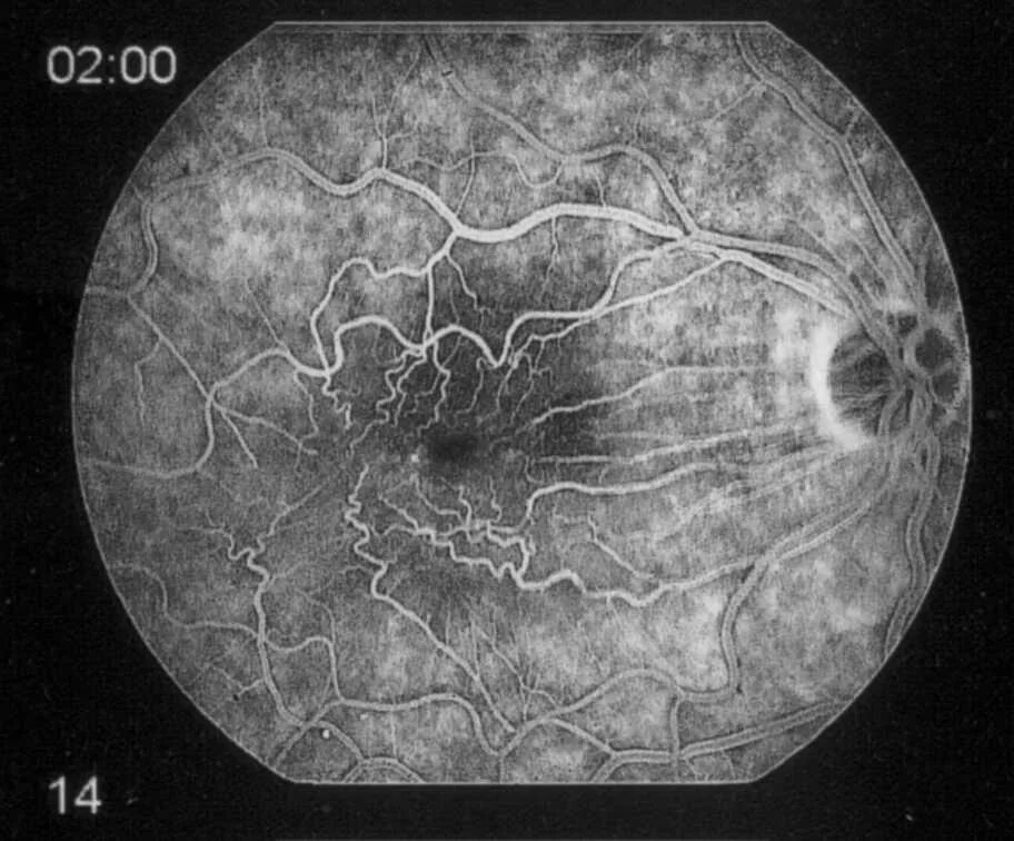Эпиретинальный фиброз глаза. Флуоресцентная ангиография глазного дна. Эпиретинальный фиброз. Флюоресцентная ангиография глазного дна. Эпиретинальная мембрана (целлофановая макула).