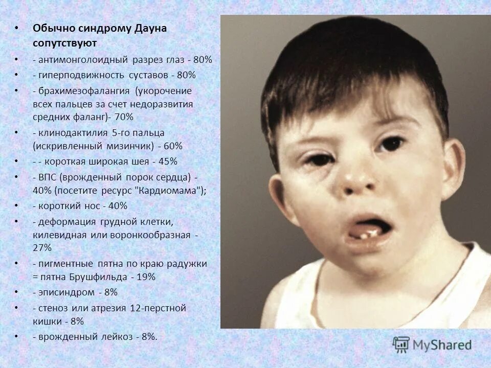 Дауны передаются по наследству. Монголоидный разрез глаз синдром Дауна. Антимоноголоидное разрез глаз. Антимонголоижный иахрез глаз. Синдромы с антимонголоидный разрез.