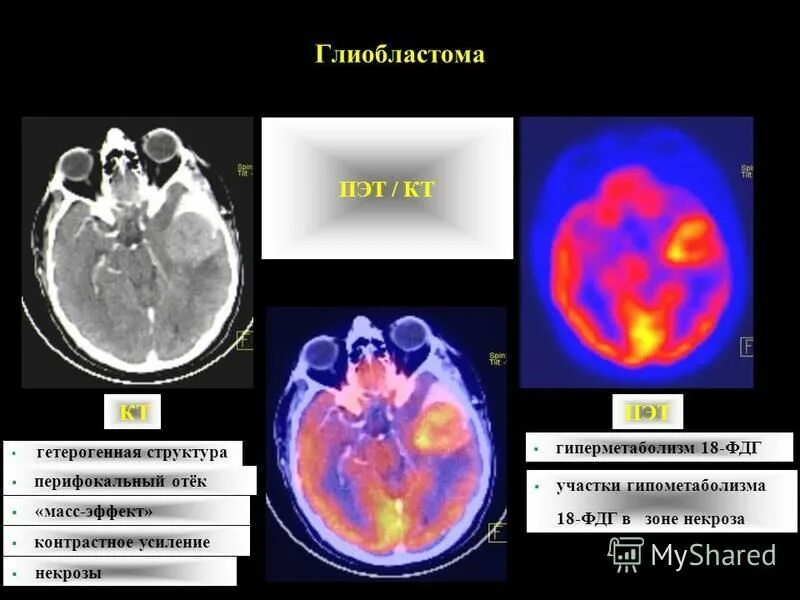 фдг при пэт кт что это