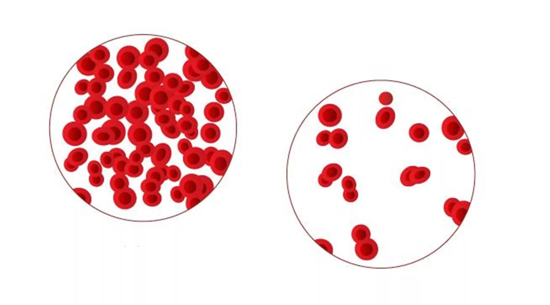 Малокровие эритроцитов. Гемоглобин классификация анемии. Эритроциты в крови анемия. Железодефицитная анемия картина крови.