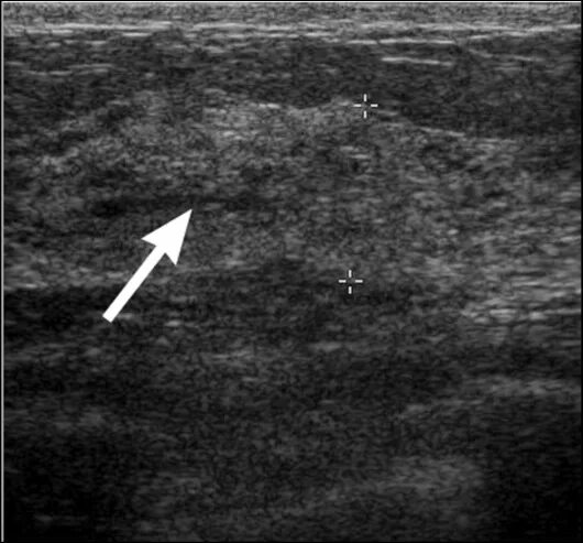 расширенные молочные протоки на узи. склерозирование кисты молочной железы. фиброма молочной железы на узи. кистозно расширенный проток молочной железы на узи. расширенный проток молочной.