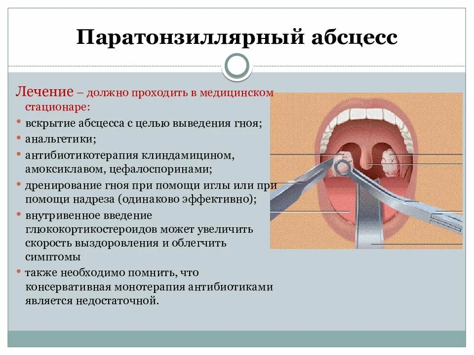 Тонзиллит код по мкб у взрослых. Паратонзиллярный абсцесс гортани. паратонзиллит абсцесс. паратензиальный абсцесс.
