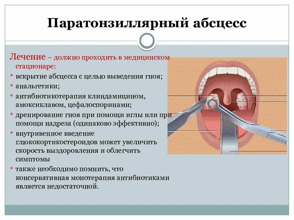 Паратонзиллярный абсцесс тризм. Патогенез паратонзиллярного абсцесса. Наружный паратонзиллярный абсцесс вскрытие. Лечение ангины гнойной у взрослых эффективные