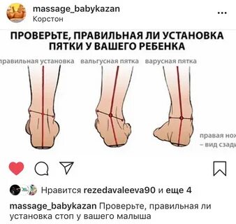 Варусная деформация стопы у детей