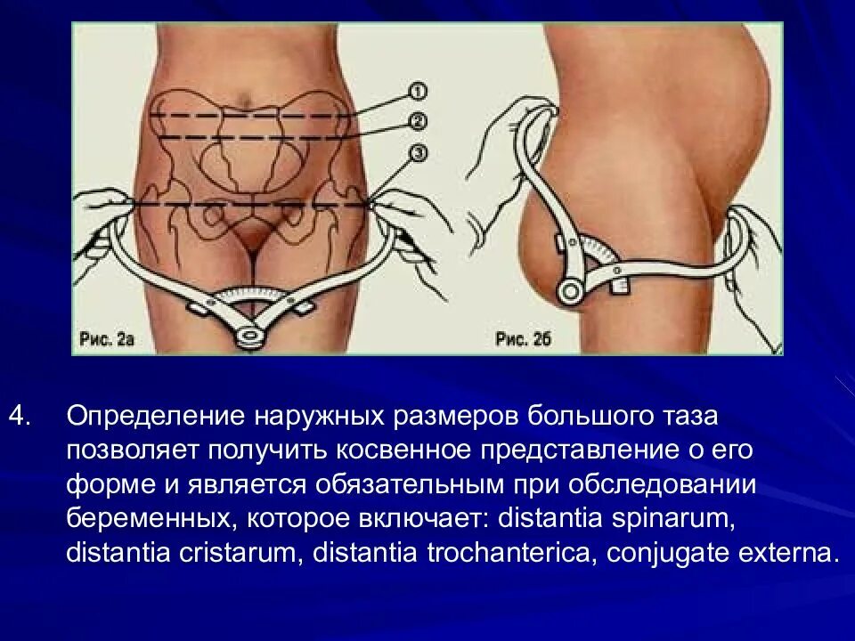 Distantia spinarum в норме. Distantia cristarum. Измерение наружных размеров большого таза. Измерение наружных размеров большого таза алгоритм