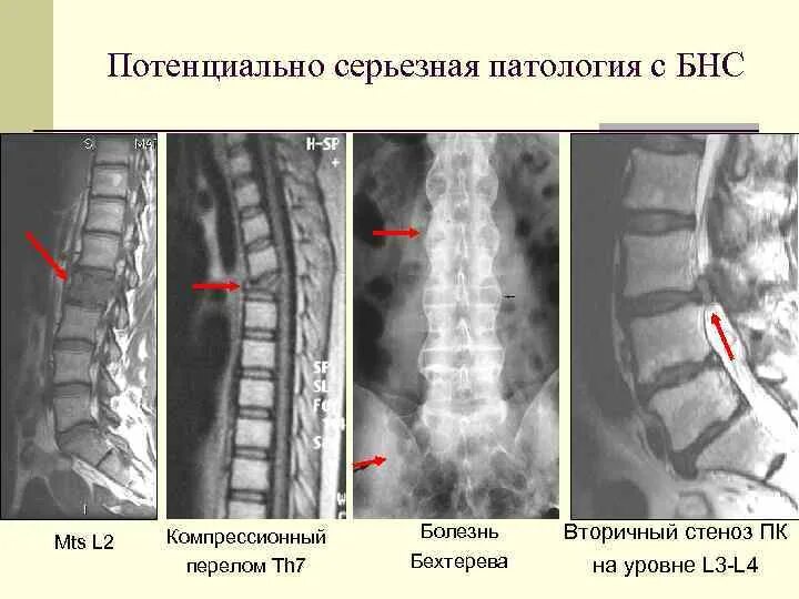 Компрессионный перелом th7. Переломы позвонков l1 l3. Компрессионный перелом l1 th12. Компрессионный перелом позвоночника th12 l3. Компрессионный перелом тела 1 1