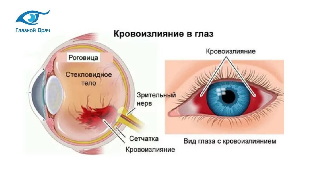 Дежурная глазные. Кератит, конъюнктивит, увеит). Птеригиум конъюнктивы пингвекула. Кровоизлияние в стекловидное тело глаза. Кровоизлияние в роговицу глаза.