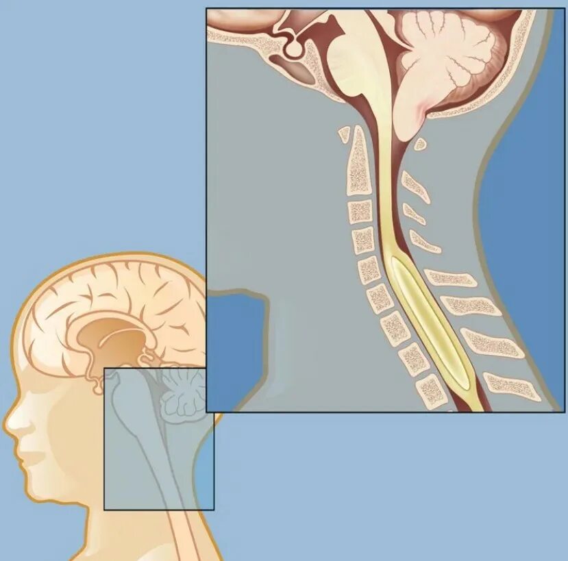 Аномалия арнольда киари что это простыми. Аномалия Арнольда-Киари 1 типа. Сирингомиелия Арнольда Киари 2. Аномалия мозга Арнольда Киари. Мальформация Киари 1 типа.
