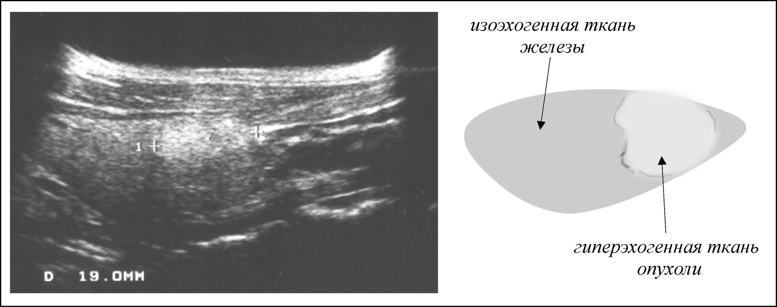 Гиперэхогенный узел в щитовидной железе УЗИ. Гиперэхогенное образование в щитовидной железе на УЗИ. Гиперэхогенное образование в молочной железе на УЗИ. Гиперэхогенный узел щитовидной железы на УЗИ. Гиперэхогенные диффузные