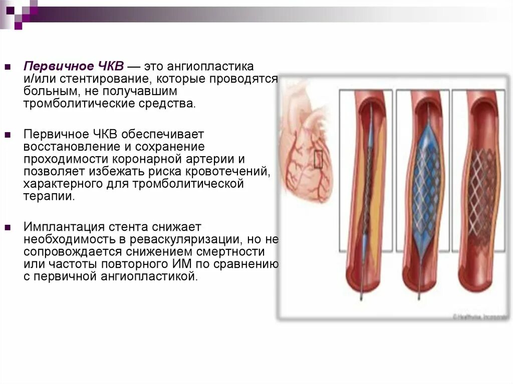 Инфаркт коронарное стентирование. Инфаркт миокарда ЧКВ. Чрескожная коронарная баллонная ангиопластика. Ангиопластика при инфаркте миокарда.