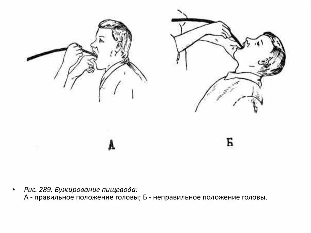 Бужирование стриктуры пищевода. Эндоскопическое бужирование. Эндоскопическое бужирование пищевода. Слепой пищевод