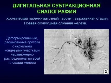 Выраженная стадия