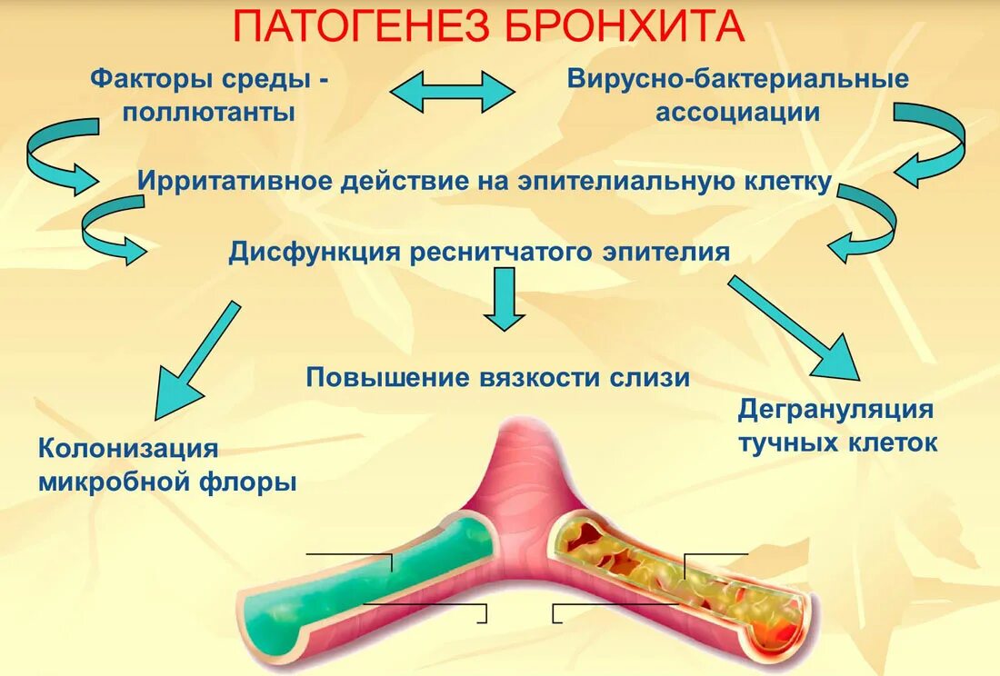 Схема бронхита. Патогенез при бронхите. Патогенез хронического бронхита. Патогенез острого и хронического бронхита. Патогенез острого бронхита.