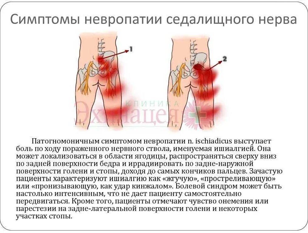 Мигрирующие неприятные ощущения проецирующиеся внутрь телесного я