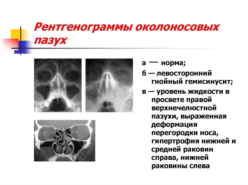 Пристеночное утолщение слизистой оболочки. Рентген придаточных пазух. Рентген пазух при гайморите. Рентген пазух носа ППН норма. Рентгенологические исследования околоносовых пазух.