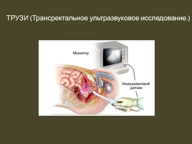 Трузи предстательной железы подготовка к исследованию