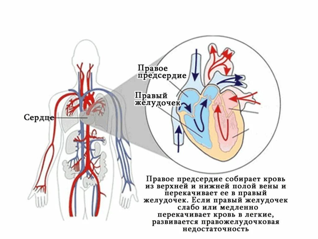 Как снять сердечную недостаточность. Острая правожелудочковая сердечная недостаточность. Симптомы правожелудочковой сердечной недостаточности. Сердечная недостаточность правого желудочка. Правожелудочковая недостаточность симптомы механизм.