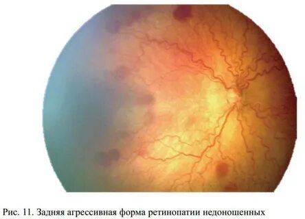 Ретинопатия у ребенка