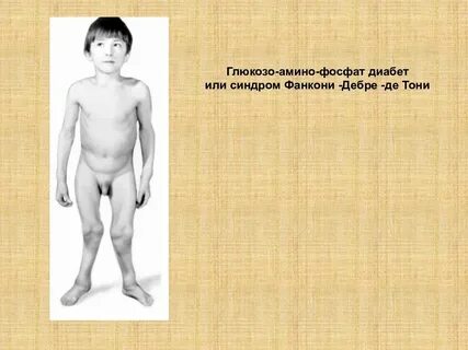 Синдром тони дебре фанкони
