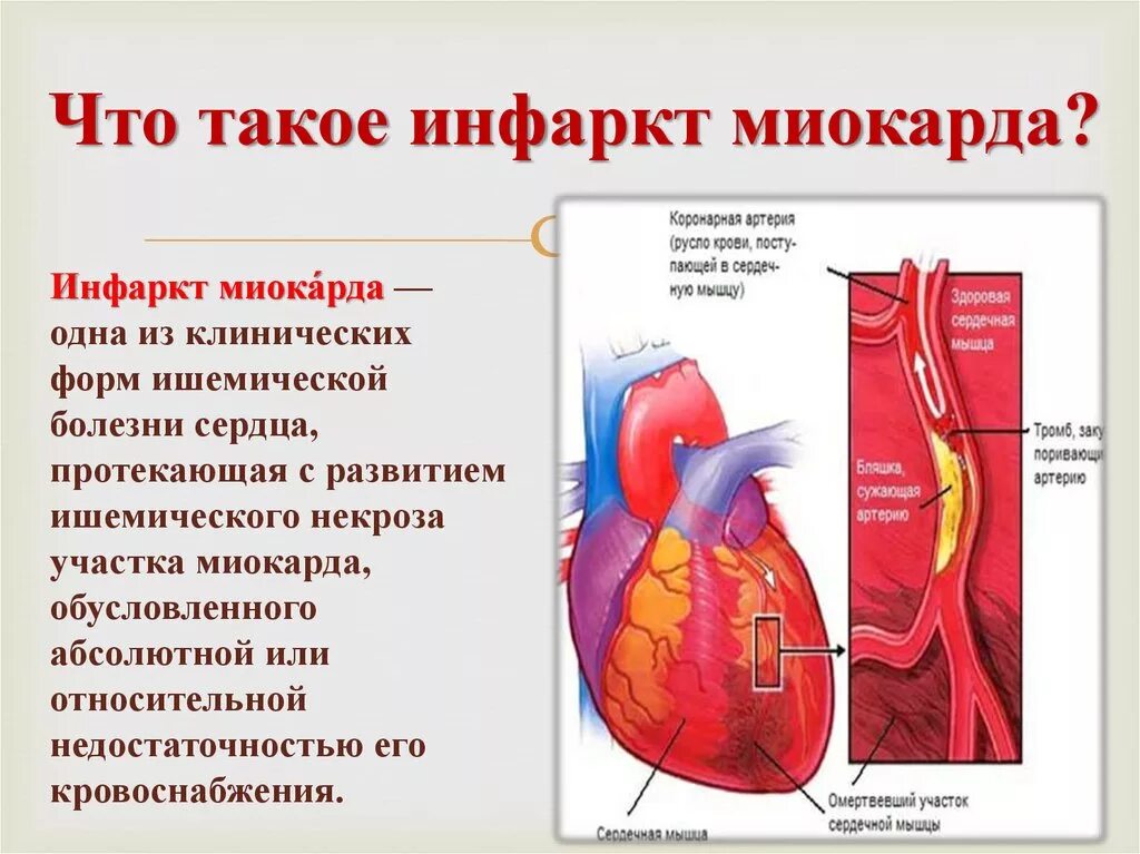 Больные с инфарктом миокарда. Инфа. Инфаркт миокарда.инфаркт миокарда..