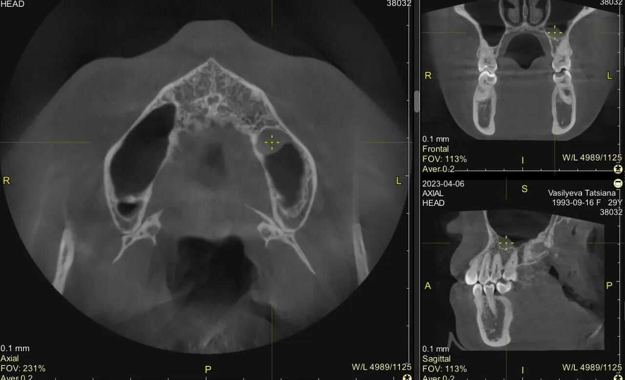 Снимки синусита на рентгене. Гайморит рентгеновский снимок. Утолщенная слизистая пазух