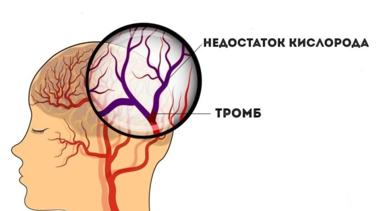 Лекарство от ишемии мозга. Ишемический инсульт головного мозга. Трмб в головке симптомы.