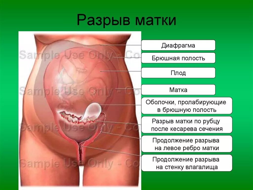 Рубец на матке мкб