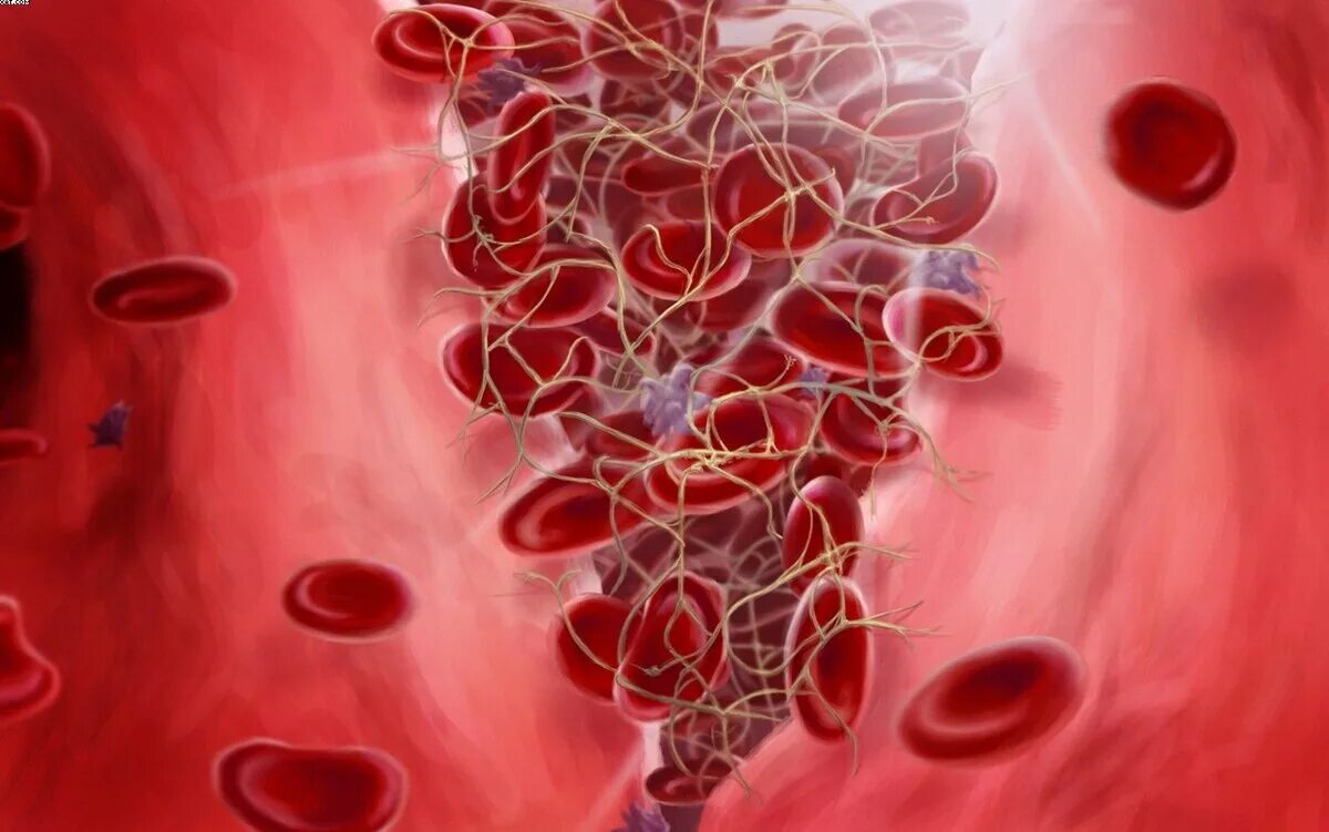 Кровяной тромб. Гемостаз крови. Внутрисосудистый гемостаз. Кровь гемостаз кровотечении. Система гемостаза крови.