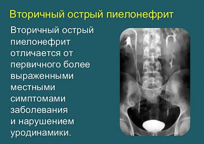 Вторичный пиелонефрит у детей. Первичный пиелонефрит. Острый пиелонефрит первичный и вторичный. Первичный и вторичный пиелонефрит у детей.