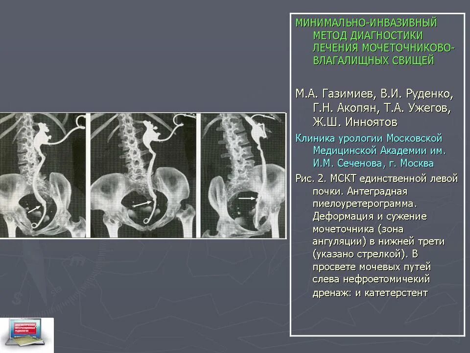 Перегиб мочеточника. S образный Перегиб мочеточника. Перегиб мочеточника в верхней трети кт. Перегиб мочеточника рентген.