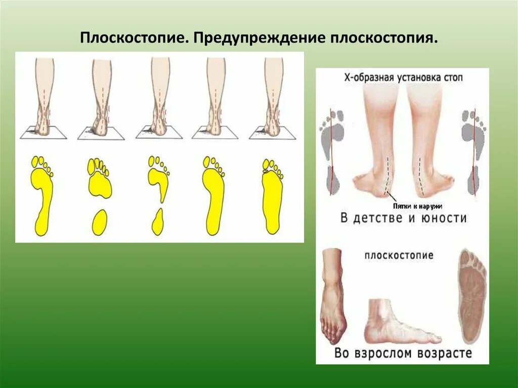 Плоскостопие может быть предотвращено. Плоскостопие. предупреждение плоскостопия. плоскостопие причины и профилактика. плоскостопие и его профилактика.