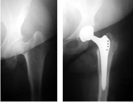 Коксартроз эндопротезирование тазобедренного сустава. Асептический некроз головки бедренной кости эндопротезирование. Эндопротез головки тазобедренного сустава. Эндопротез кости бедра. Некроз шейки бедра