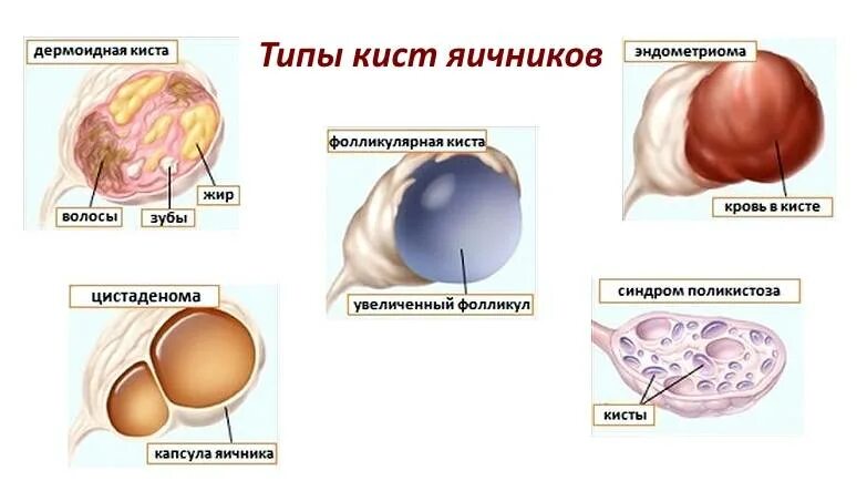 Эндометриоидная киста (вид на лапароскопии). Фолликулярная киста операция. Цистаденома и киста яичников. Киста яичника функциональная и эндометриозная. Лечение яичника у мужчин