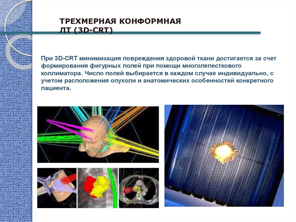 Конформная лучевая. Трехмерная конформная лучевая терапия. Трехмерная конформная лучевая терапия (3d-CRT). Многолепестковый коллиматор в лучевой терапии. Конформная Дистанционная лучевая терапия это.