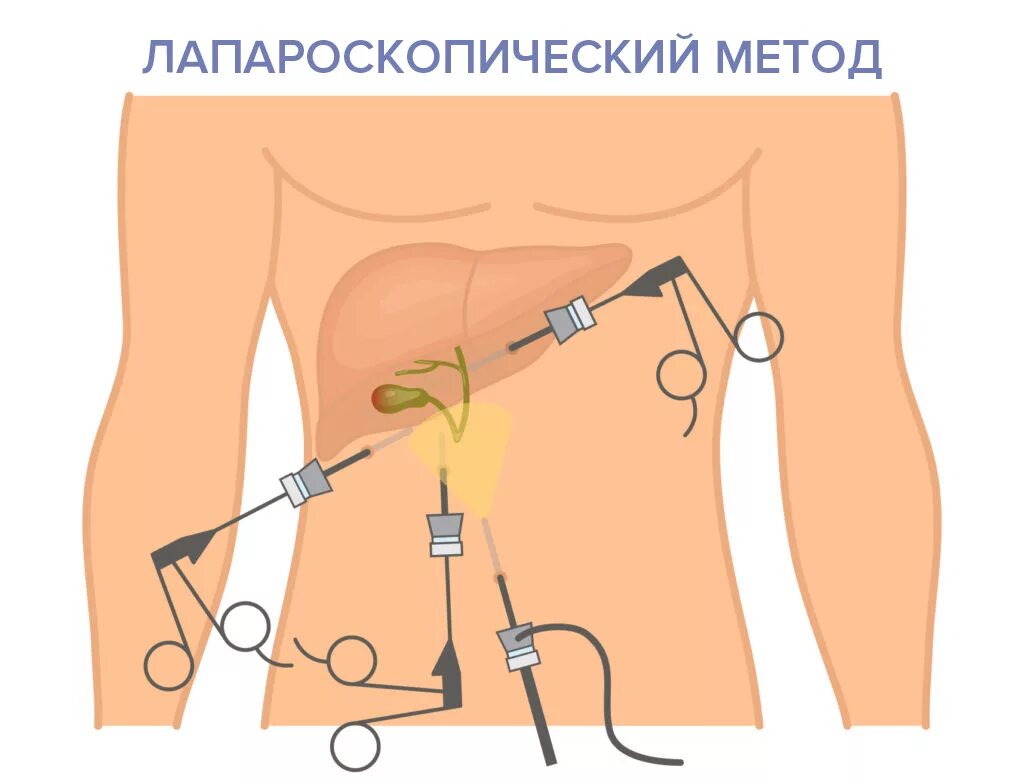 Трубка в желчном пузыре. Лапароскопия желчного пузыря хирургия. Лапароскопия желчного шрамы. Лапароскопическая холецистэктомия схема операции. Лапароскопия холецистэктомия ход операции.