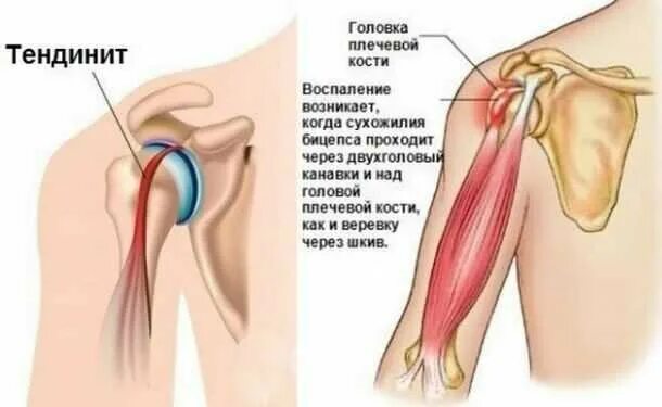 Тендовагинит бицепса. Тендинит сухожилия плеча. тендинопатия сухожилия двуглавой мышцы плеча. тендинит сухожилия бицепса тендинит бицепса. тендинит сухожилия бицепса плечевого сустава.