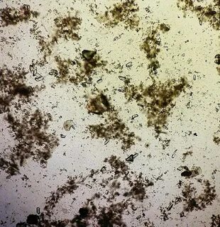 Песок в моче лечение ImmunoCap.ru