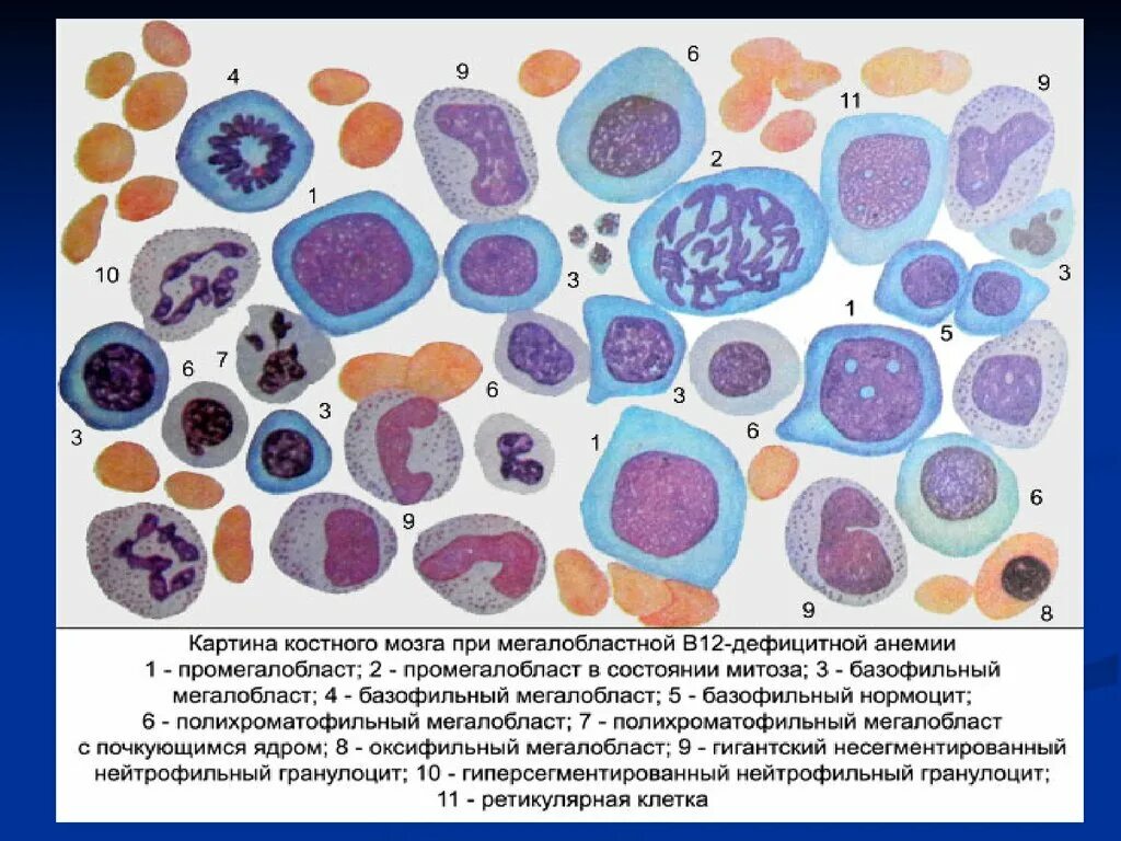 Мазок крови при выявлении патологии что это. Б12 дефицитная анемия мазок крови. В12 дефицитная анемия миелограмма. Костный мозг при в12 дефицитной анемии. Б12 дефицитная анемия красный костный мозг.