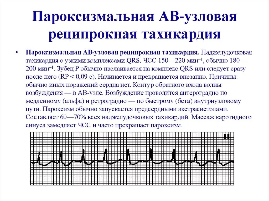 Атриовентрикулярная Узловая реципрокная тахикардия. ЭКГ – критерии пароксизма наджелудочковой тахикардии.. Av реципрокная пароксизмальная тахикардия ЭКГ. Пароксизмальная АВ Узловая реципрокная тахикардия на ЭКГ.