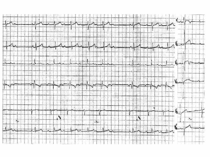 Изменения миокарда предсердий. Умеренные диффузные изменения миокарда на ЭКГ. ЭКГ при ДТЗ. Метаболические изменения миокарда диффузного характера. ЭКГ. Диффузные неспецифические изменения миокарда.